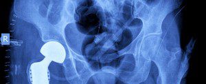 depuy hip replacement xray